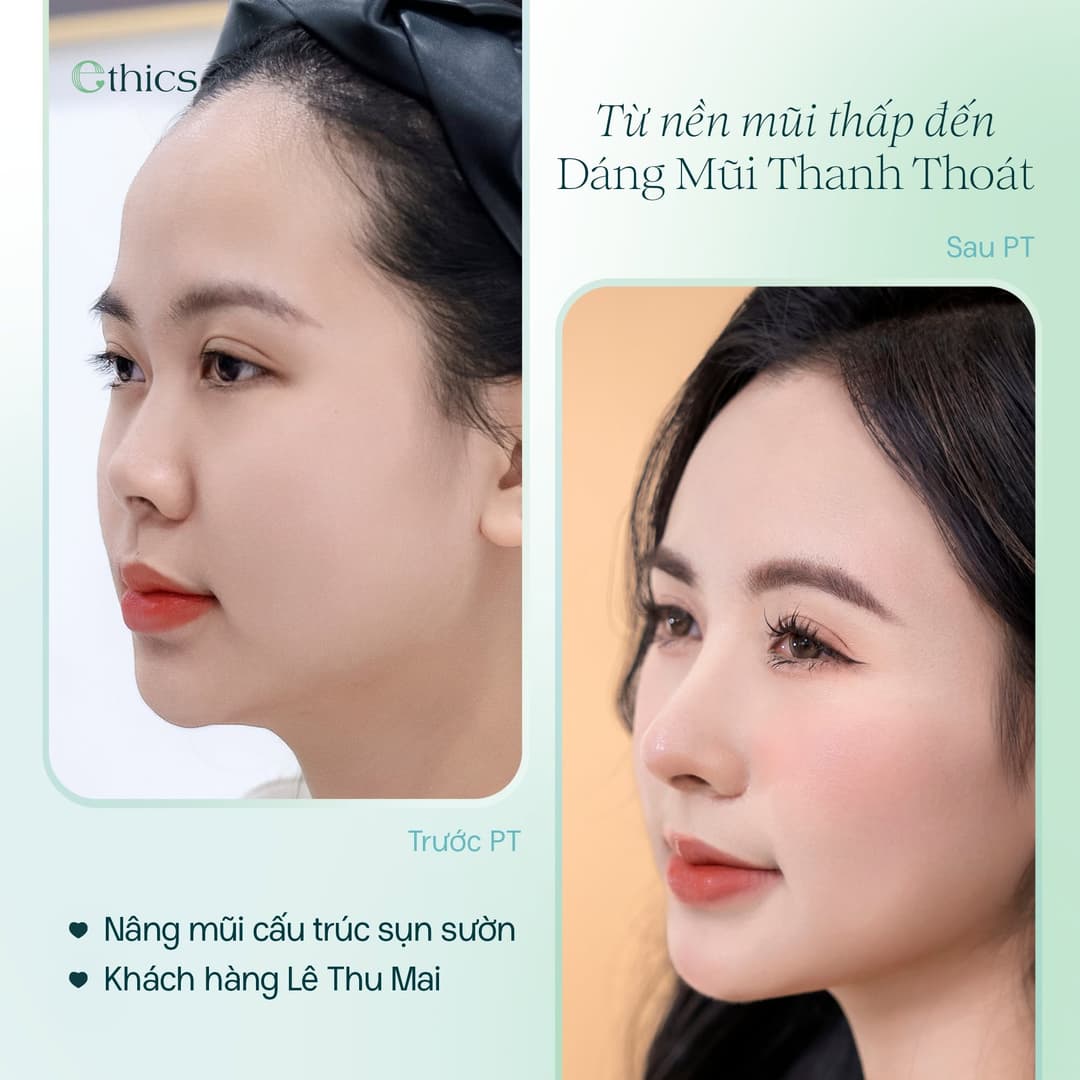 Foto kasus rinoplasti struktural tulang rawan costa Lê Thu Mai yang dipublikasikan Ethics pada 20/09/2026