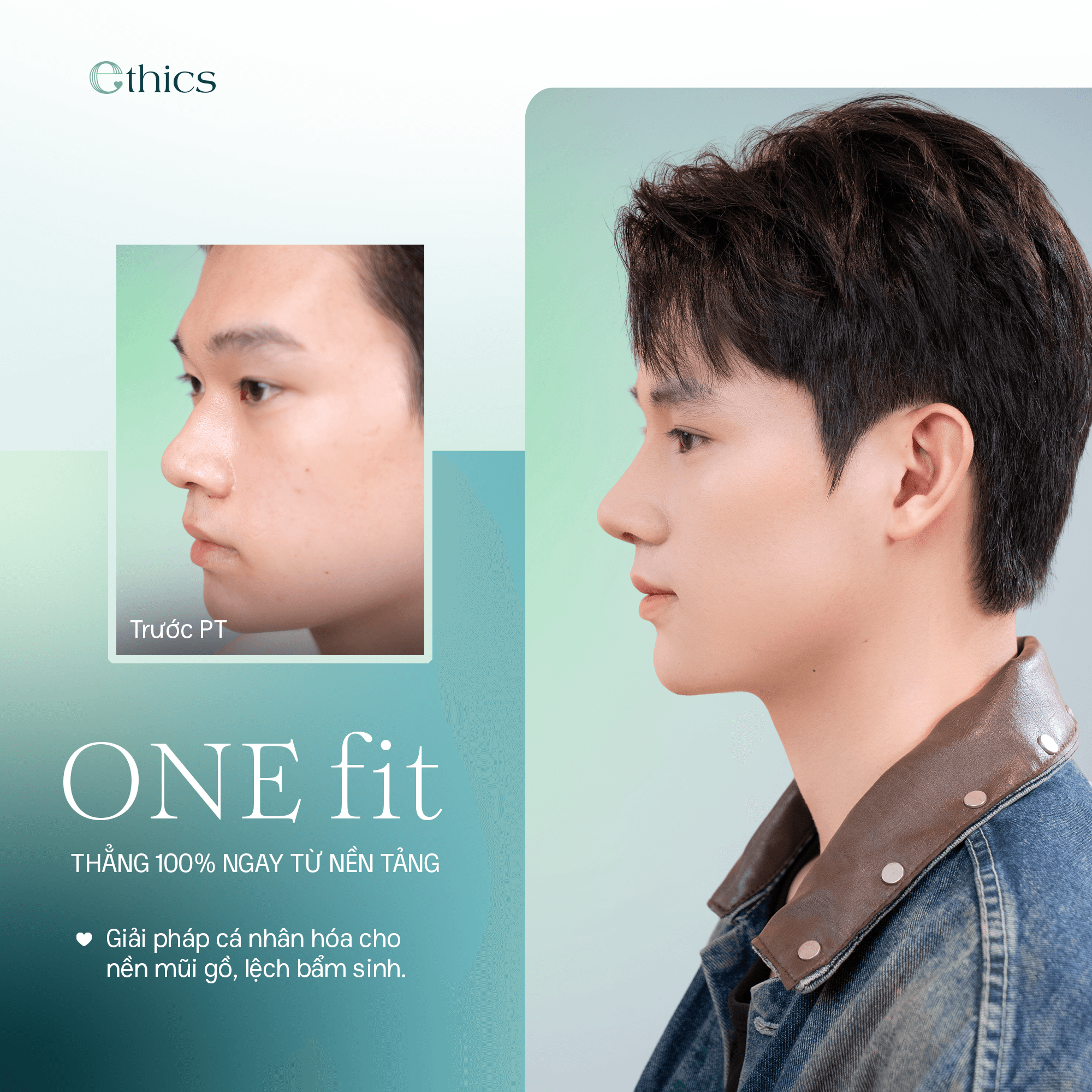 Operasi hidung OneFit
