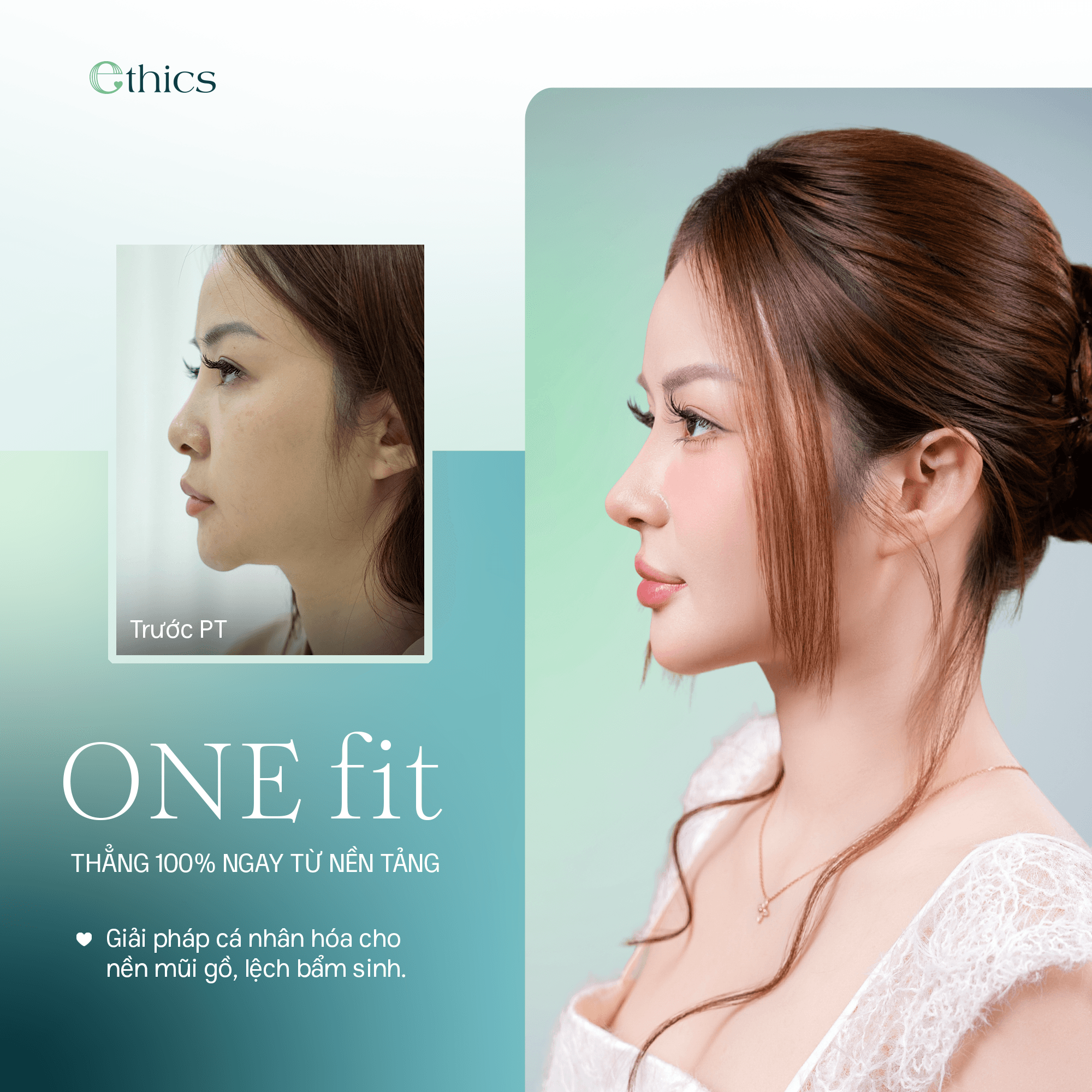 Operasi hidung OneFit Premium