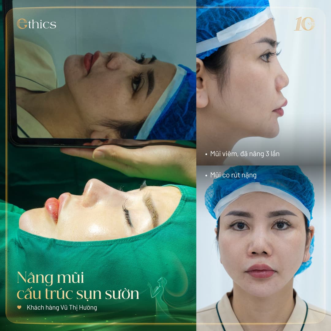 Cangkok tulang rawan autolog untuk koreksi hidung Ethics