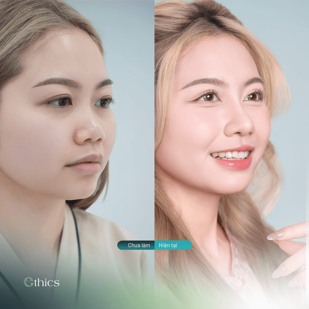 Perbandingan foto sebelum dan sesudah rhinoplasti pasien