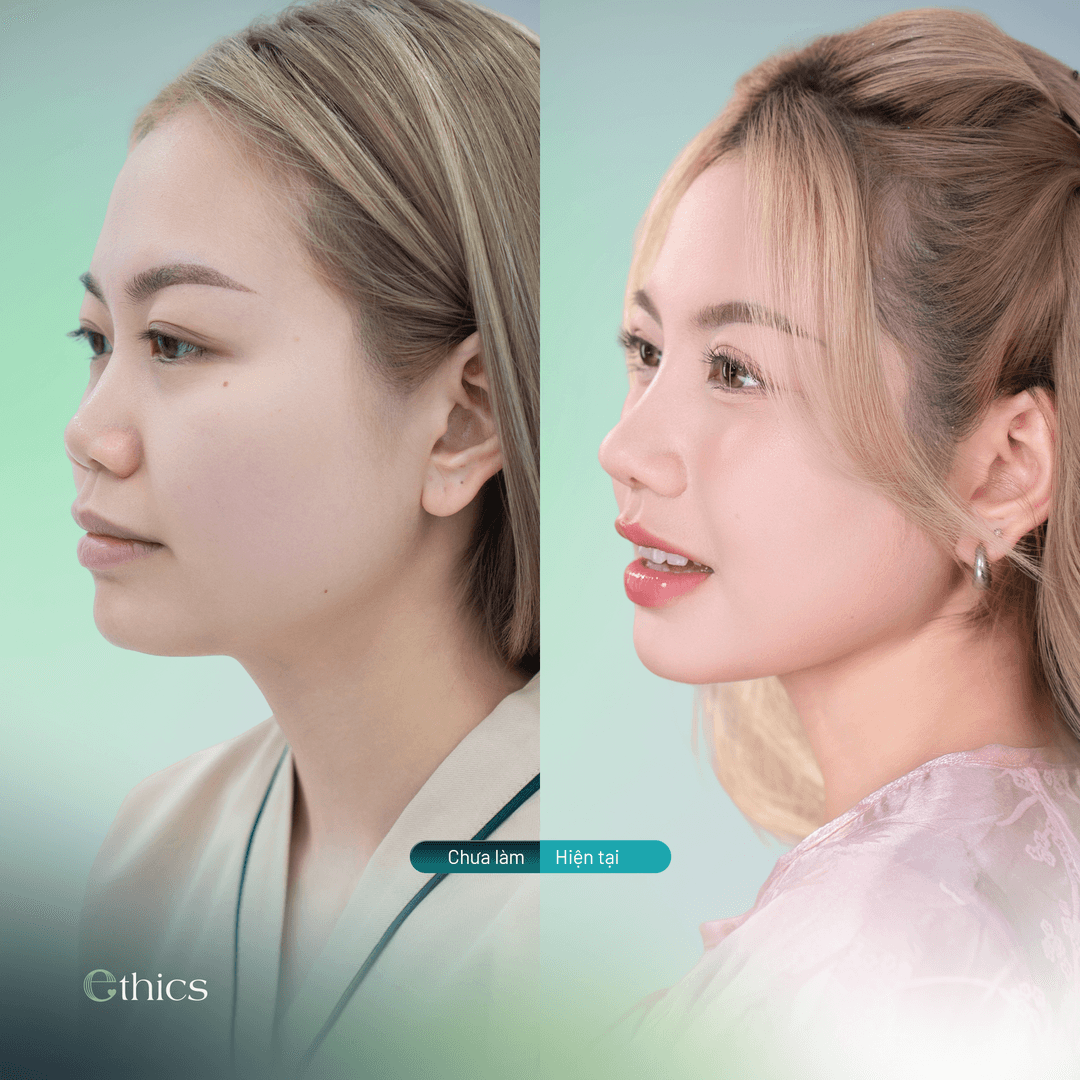Gambar perbandingan sebelum dan sesudah rhinoplasty pasien