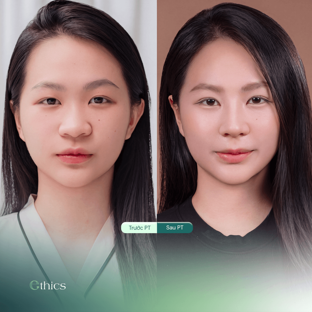 Berikut adalah foto perbandingan sebelum dan sesudah prosedur rhinoplasty (operasi hidung) struktural pada seorang pelanggan