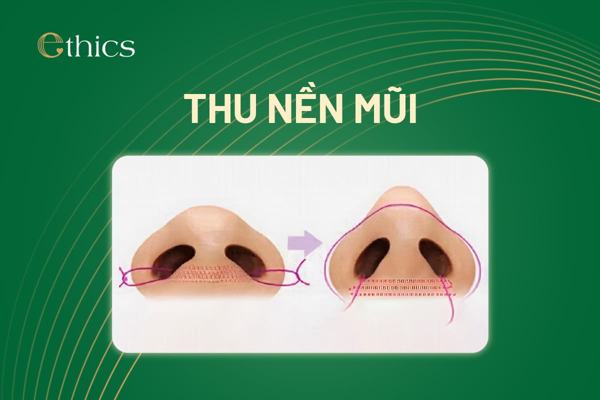 Penyempitan Dasar Hidung