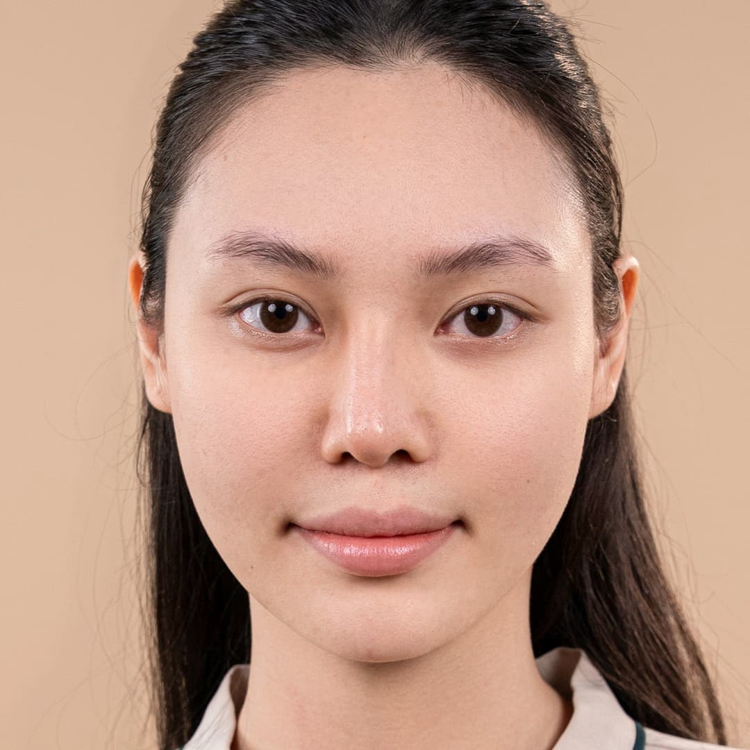 Pasien Lưu Phương Anh - Sebelum tindakan rinoplasti One fit