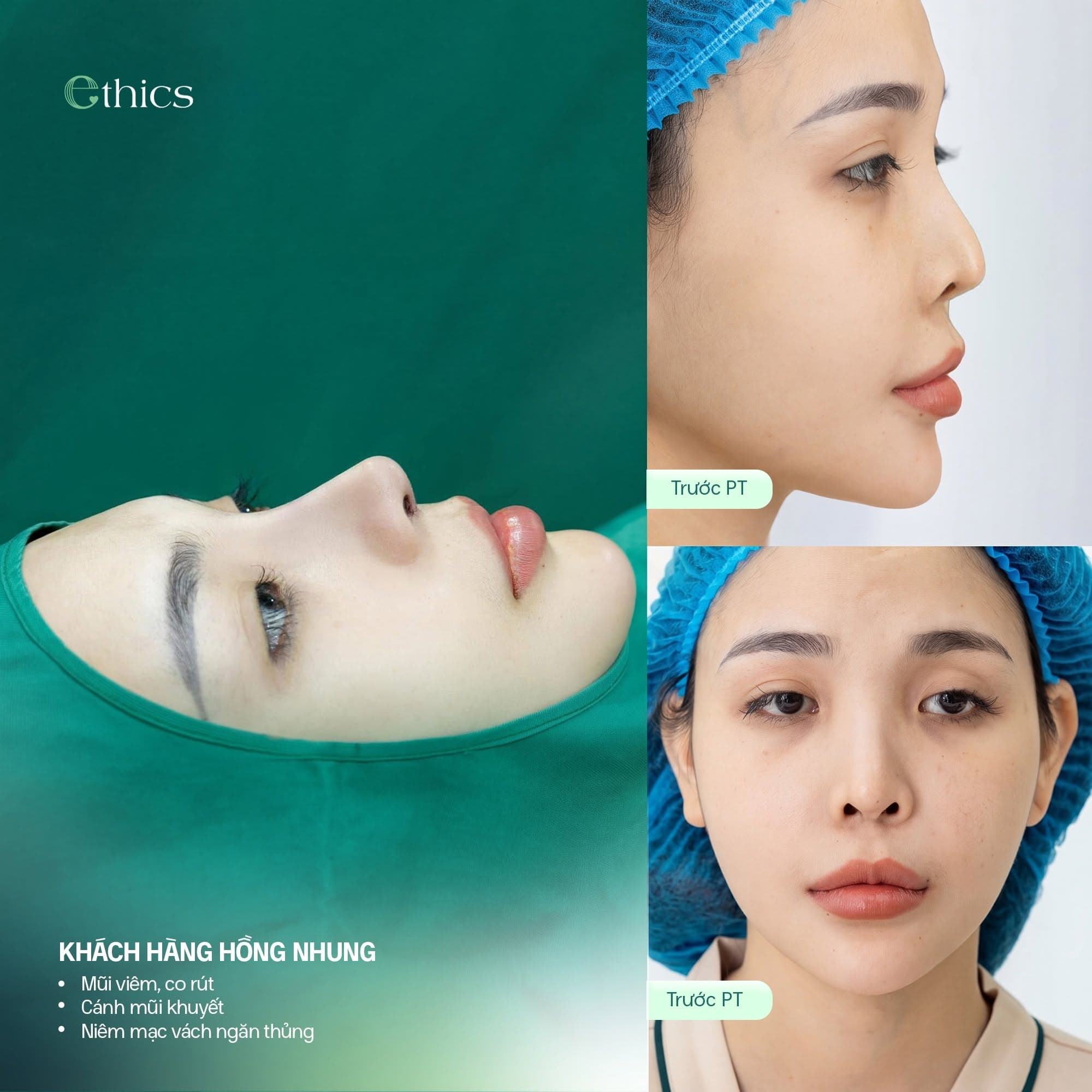 Bagaimana Cara Memilih Tulang Rawan Iga dan Tulang Rawan Septum untuk Rinoplasti?