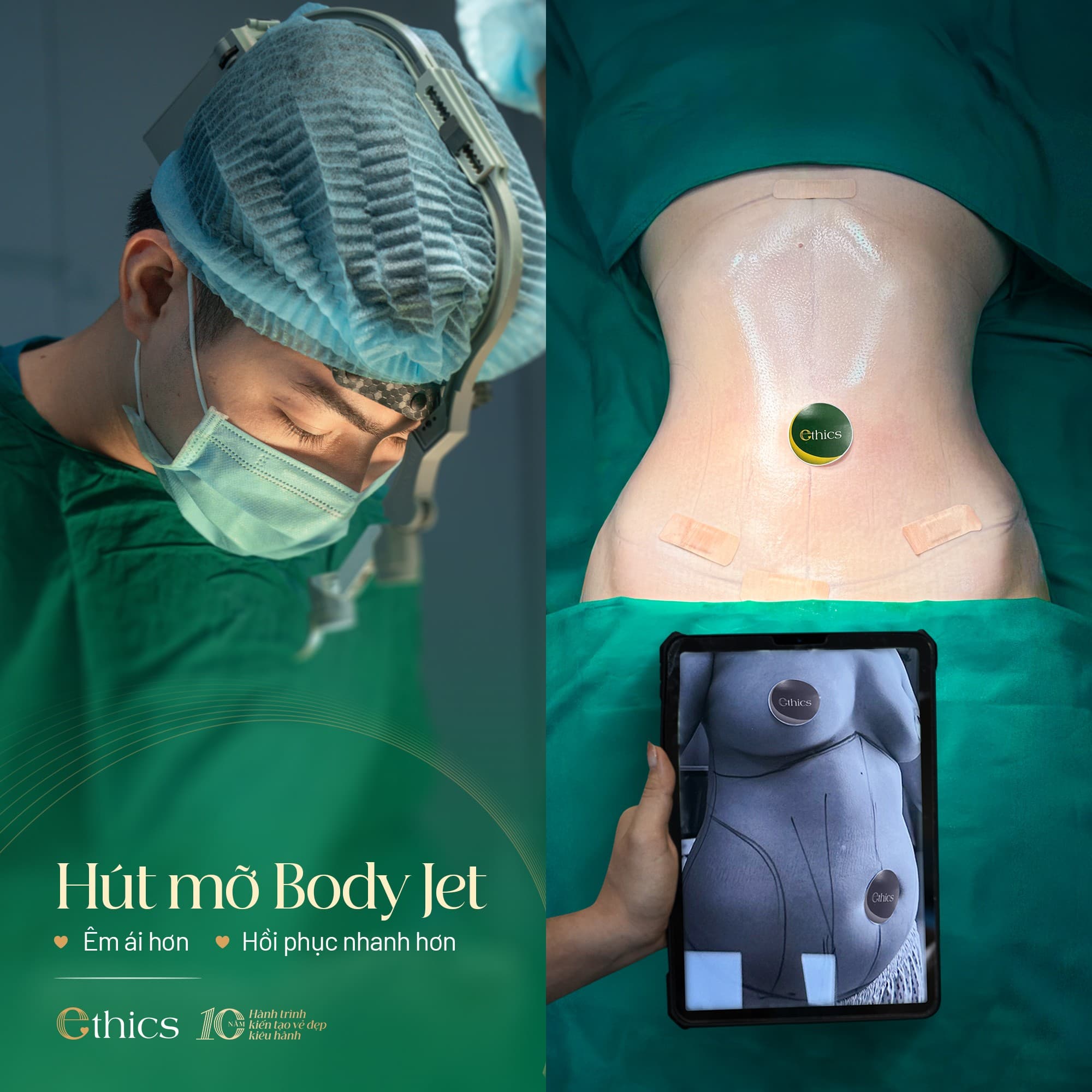 Sedot lemak Body Jet