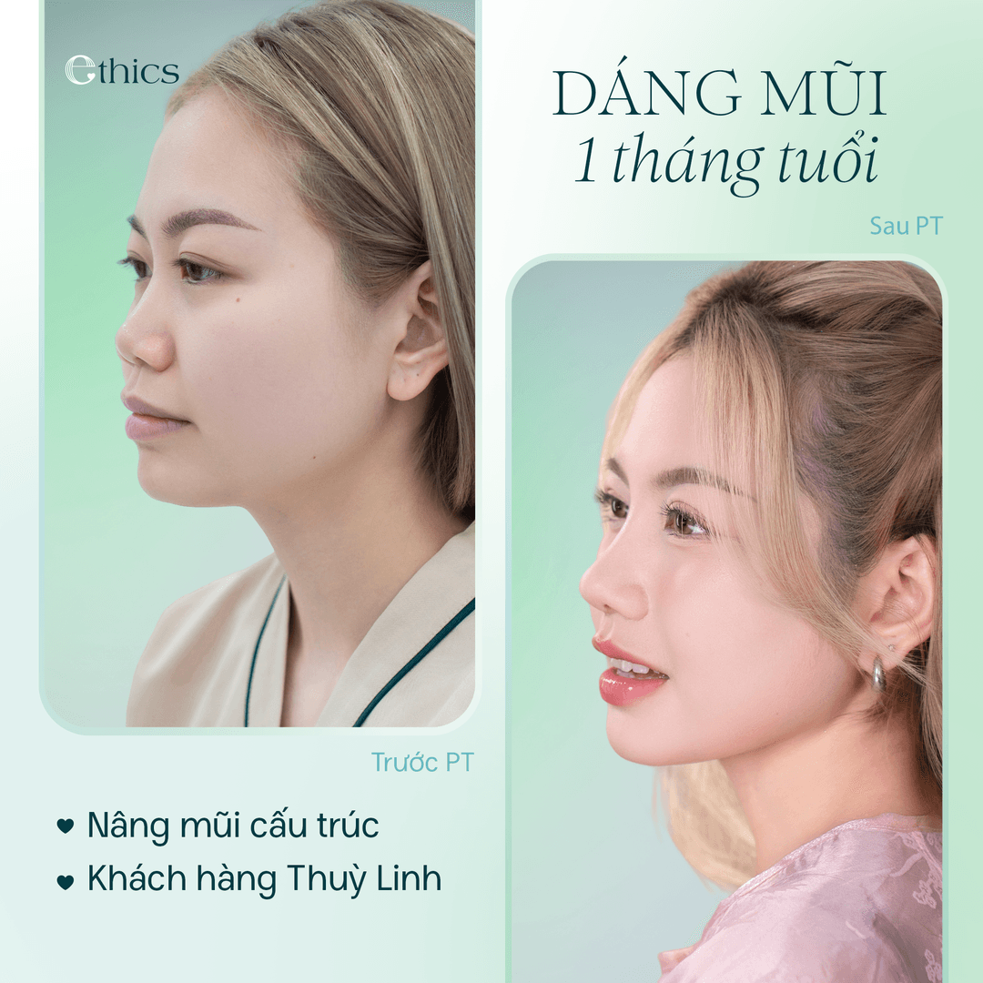 Gambar perbandingan sebelum dan sesudah operasi hidung struktur pelanggan